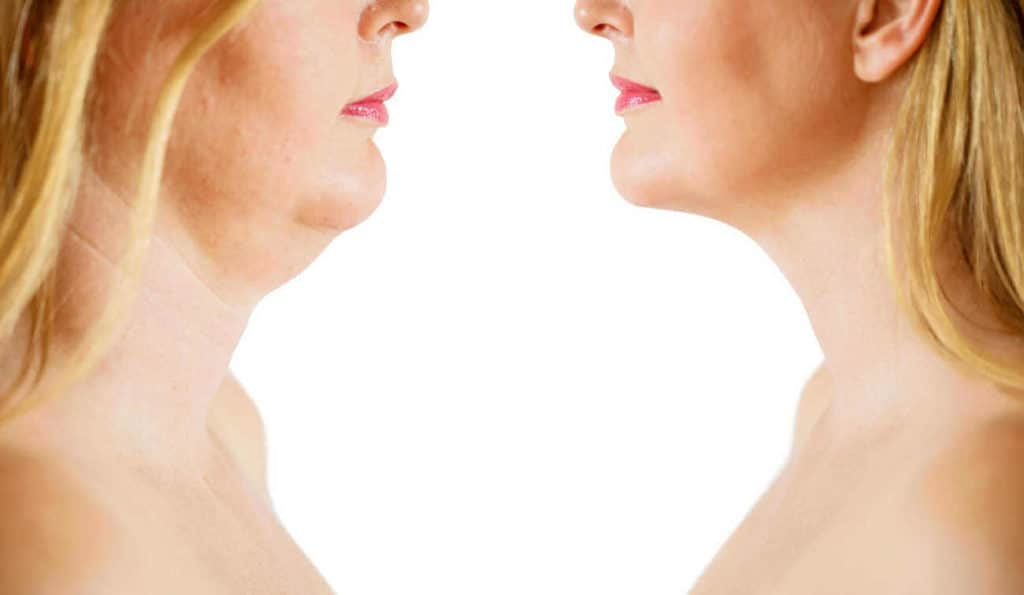 Double Chin treatment Didcot before and after results