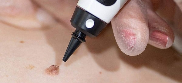 After Skin Tag Removal Didcot