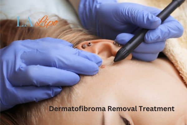 Dermatofibroma Removal Treatment Didcot
