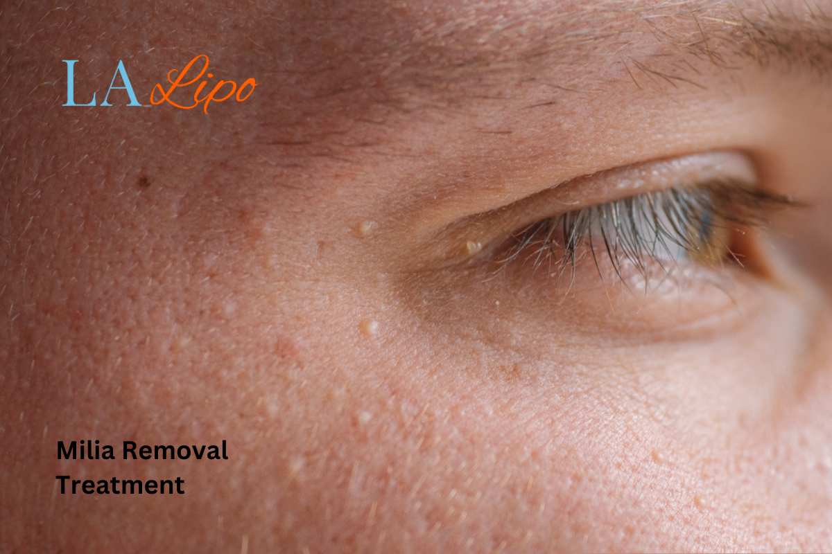Cryopen Milia Removal: Is It the Easiest and Safest Option Didcot?
