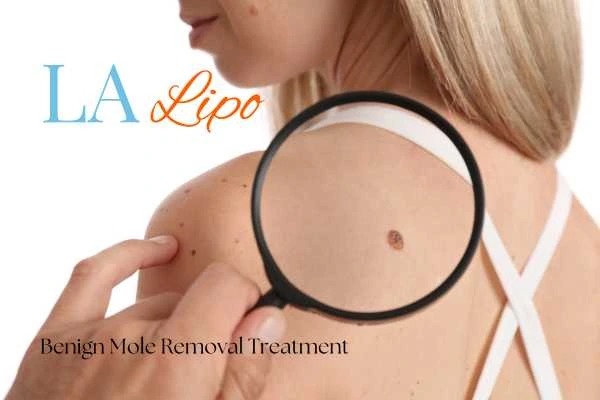 Woman having her inspection of blemish before mole removal Didcot