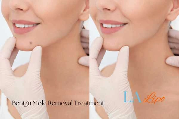 woman's before and after mole removal Didcot results