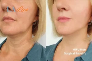 hi-fu for wrinkles Didcot before and after results