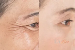 Before and after results of woman - HI-fu wrinkles reduction treatment Didcot