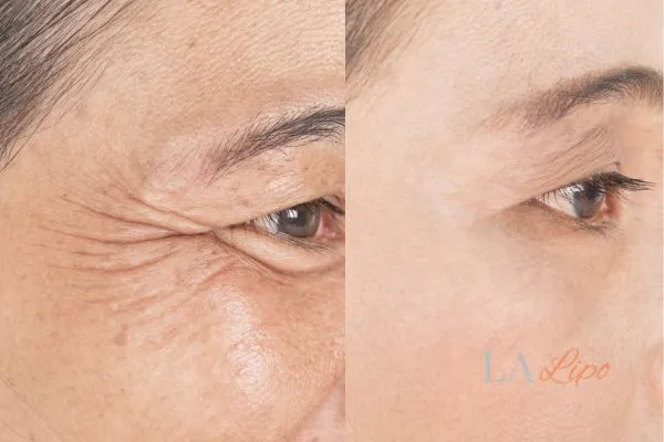 Before and after results of woman - HI-fu wrinkles reduction treatment Didcot