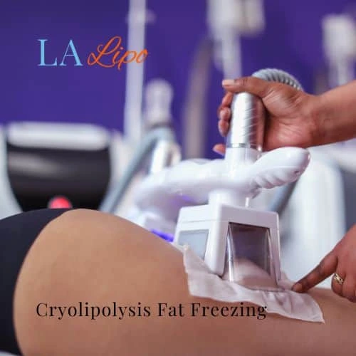 fat freezing - Cryolipolysis Didcot
