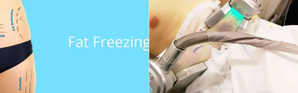 Fat freezing Didcot on multiple areas of the body