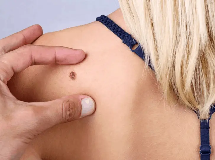 woman having mole removal Didcot consultation before treatment.