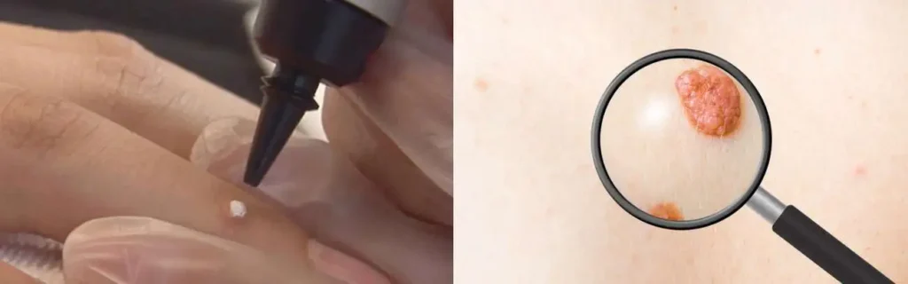 Cryopen for mole removal Didcot - speak to our team today!
