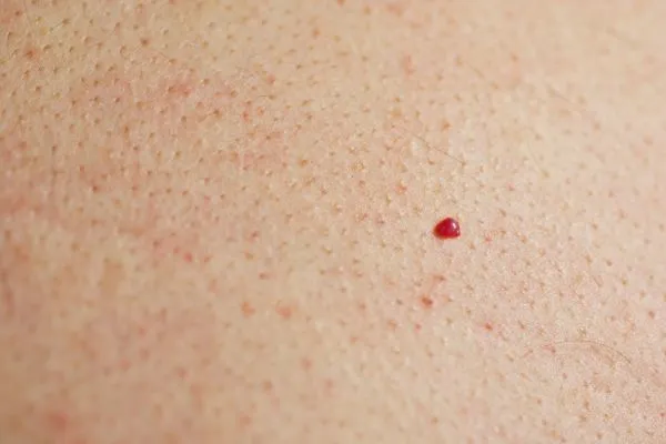close up of a cherry angioma Didcot