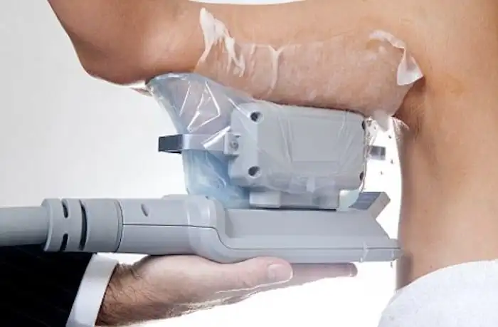 Picture of fat freezing Didcot on the upper arms.