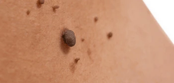 image of a skin tag Didcot
