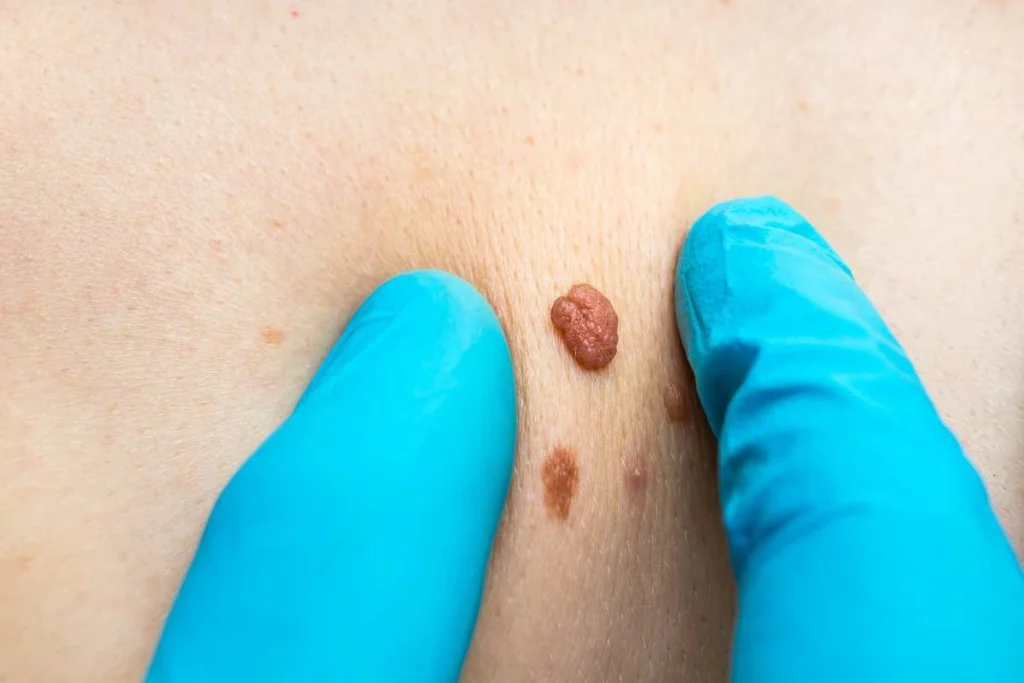 Consultant examining a skin tag Didcot