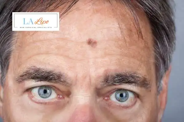 Solar Lentigo Removal Didcot image of man with mark on his forehead