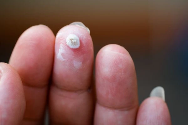 wart on person finger - cryotherapy to treat from LA LIPO Didcot