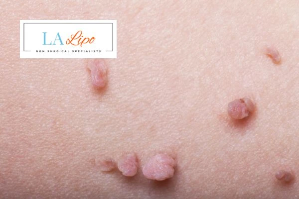 Does cryopen skin tag removal Didcot hurt? Find out now call our team today!