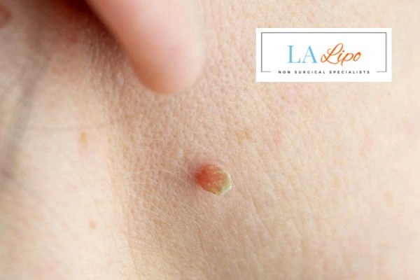 Book skin tag removal Didcot today speak to our team now!