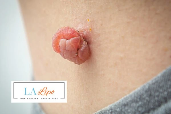 Interested in skin tag removal Didcot? Concerned about the pain? Find out more today!