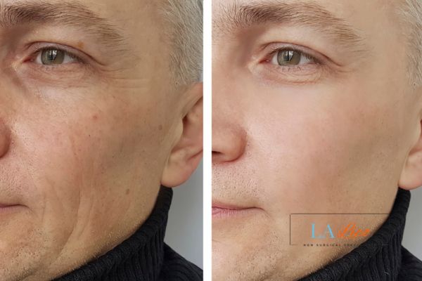 See the amazing results of Morpheus8 Treatment Didcot!