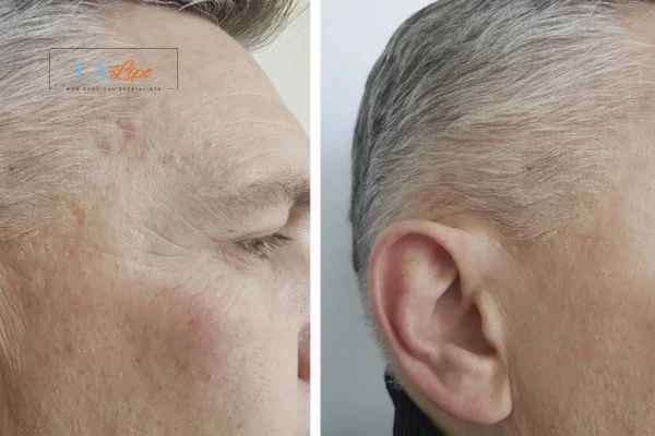 Mens Before & After Morpheus 8 Results Didcot