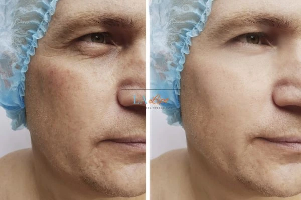 Before and after Morpheus 8 Results Didcot