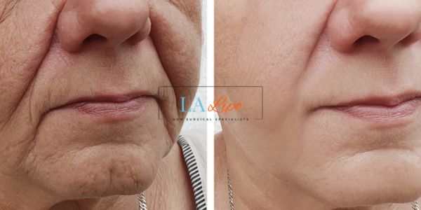 Older lady deeper wrinkle reduction - LA LIPO Morpheus 8 Results Didcot