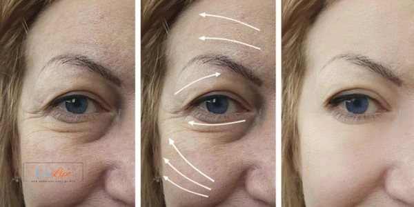 Amazing eye lift Morpheus 8 results Didcot