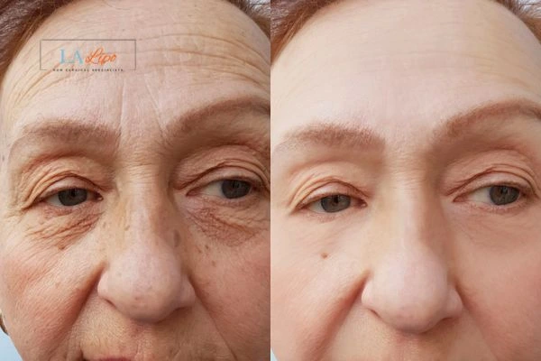 The powerful benefits of Morpheus8 Treatment Didcot - Call Our team today!