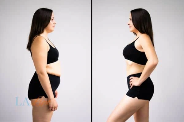 Picture of womans before and after using LA-EMS body sculpting to improve her core strength Didcot
