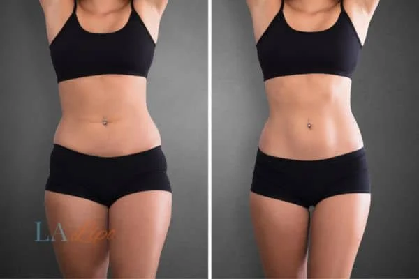 before and after results of non-surgical treatment to help a woman's body image and mental health Didcot