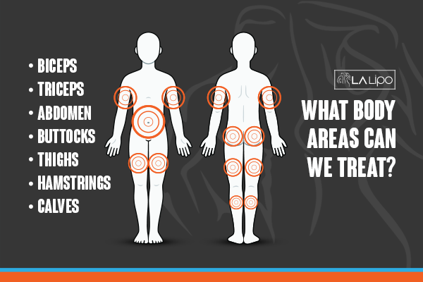 Diagram to show areas you can have LA-EMS Body Sculpting Treatment Didcot