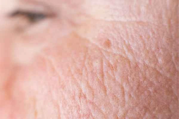 close up picture of a woman's face showing an age spot Didcot