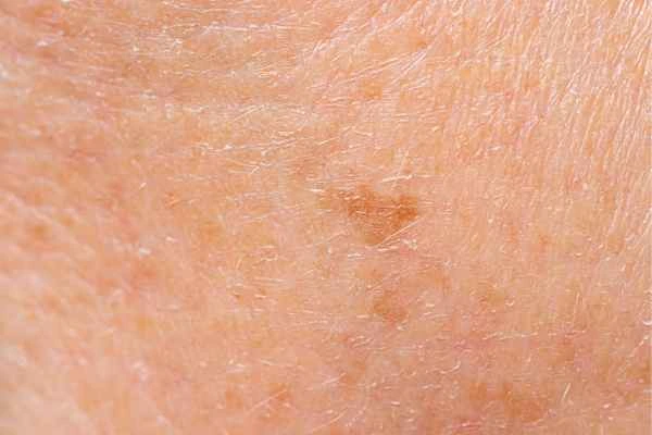 close up picture of age spots Didcot