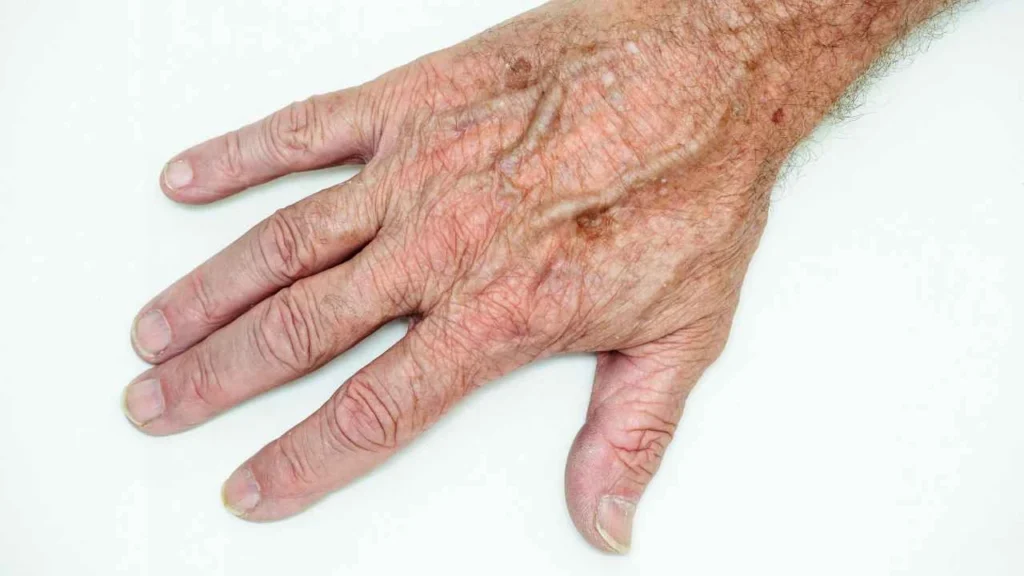 Male hand showing age spot Didcot