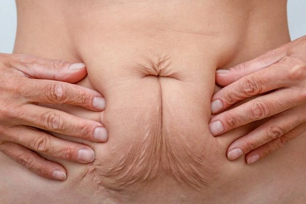 Image of a woman's stomach with loose skin - example of skin tightening Didcot options